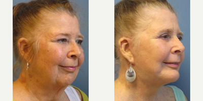 Facelift before and after photo