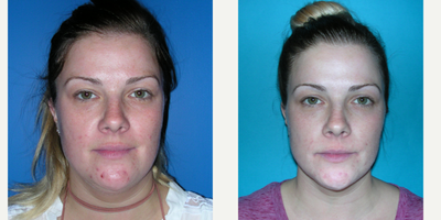 IPL before and after photo