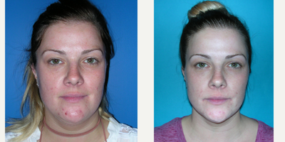 IPL before and after photo