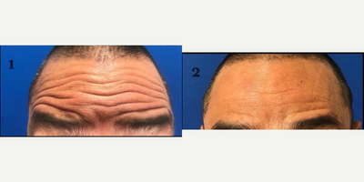 Xeomin before and after photo