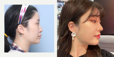 Asian Rhinoplasty before and after photo