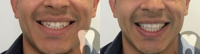 Porcelain Veneers before and after photo