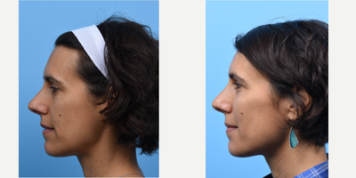 Cheek Fillers before and after photo