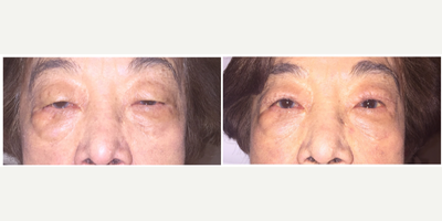 Double Eyelid Surgery before and after photo