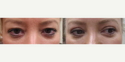 Eyelid Surgery before and after photo