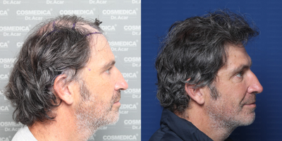 Hair Transplant before and after photo
