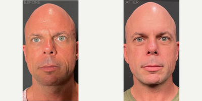 Morpheus8 before and after photo