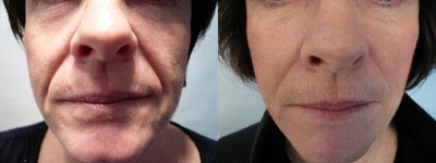Radiesse before and after photo