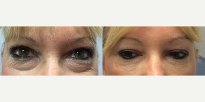 Restylane Silk before and after photo