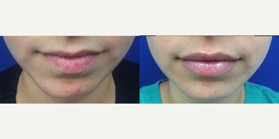 Restylane before and after photo
