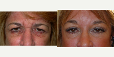 Brow Lift before and after photo