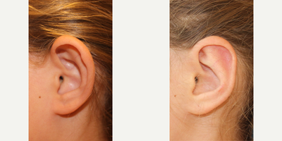 Ear Surgery before and after photo