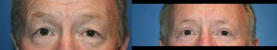 Eyelid Surgery before and after photo