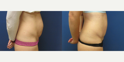Tummy Tuck before and after photo