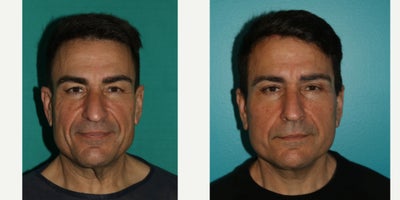 Facelift before and after photo