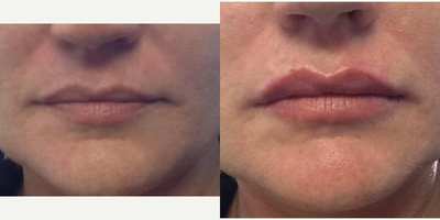 Restylane Lyft before and after photo