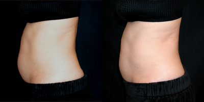SculpSure before and after photo
