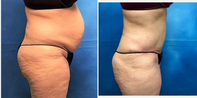 Tummy Tuck before and after photo