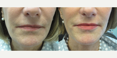 Restylane Silk before and after photo