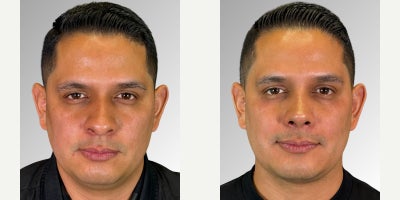 Rhinoplasty before and after photo