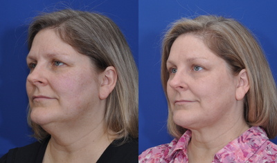 Chin Liposuction before and after photo