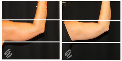 CoolSculpting before and after photo
