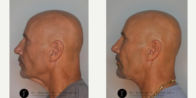 FaceTite before and after photo