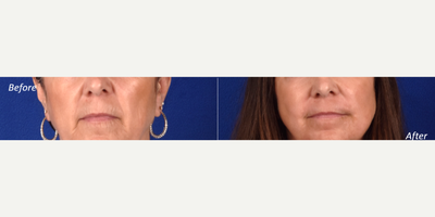 Laser Resurfacing before and after photo