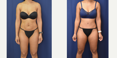 Tummy Tuck before and after photo
