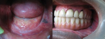 Dental Implants before and after photo