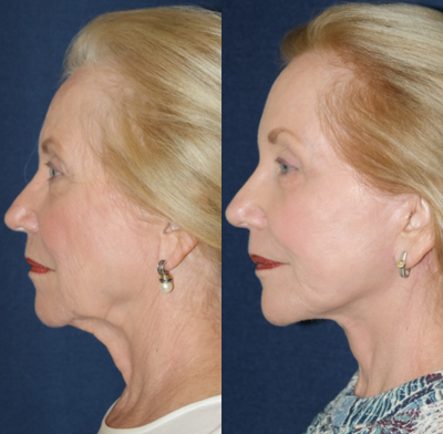 Facelift before and after photo