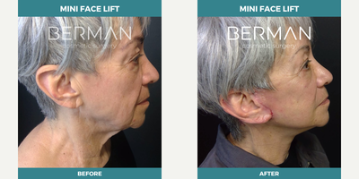 Facelift before and after photo
