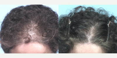 Hair Transplant before and after photo