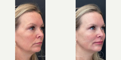 Restylane Kysse before and after photo