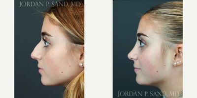 Rhinoplasty before and after photo