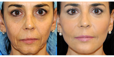 Dermal Fillers before and after photo