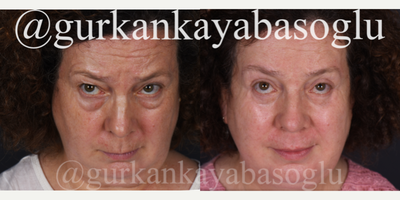 Eyelid Surgery before and after photo