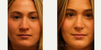 Rhinoplasty before and after photo