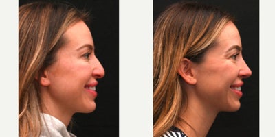 Rhinoplasty before and after photo