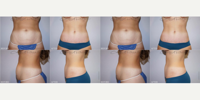 Breast Lift with Implants before and after photo