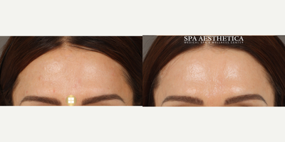 CO2 Laser before and after photo