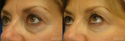 Eyelid Surgery before and after photo