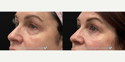 Eyelid Surgery before and after photo