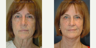 Facelift before and after photo