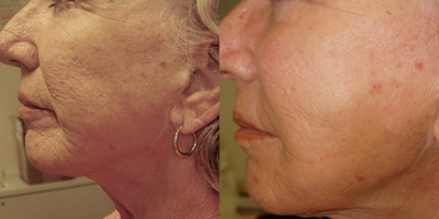 Facial Fat Transfer before and after photo