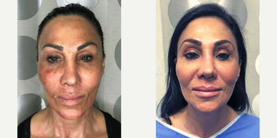 Nonsurgical Facelift before and after photo