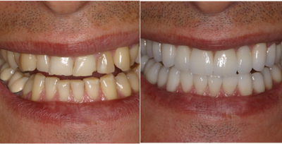 Porcelain Veneers before and after photo