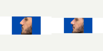 Restylane before and after photo