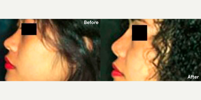 Rhinoplasty before and after photo