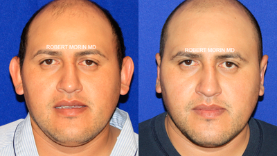 Ear Surgery before and after photo